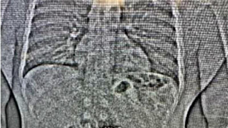  Beweisfindung per Röntgenbild. 