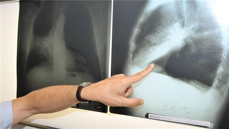 Ab April soll es losgehen mit dem neuen Programm zur Früherkennung von Lungenkrebs.