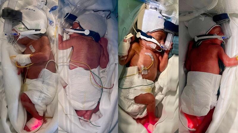 Viereiige Vierlinge in Hamburger Klinik geboren Aman, Awan, Arina und Arin wurden in der 30. Schwangerschaftswoche als Frühchen geboren. Sie sind stabil, benötigen aber noch medizinische Unterstützung und werden beatmet.