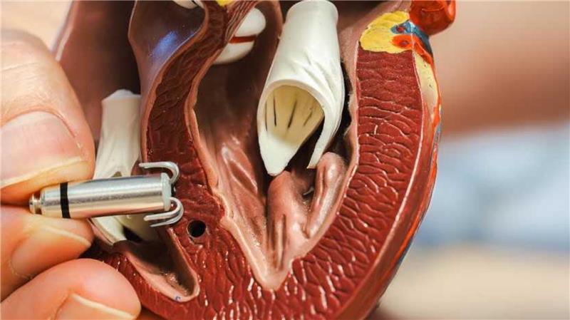 An der Herzscheidewand der rechten Herzkammer wird der sondenlose Schrittmacher transplantiert. Haltearme fixieren ihn dort.