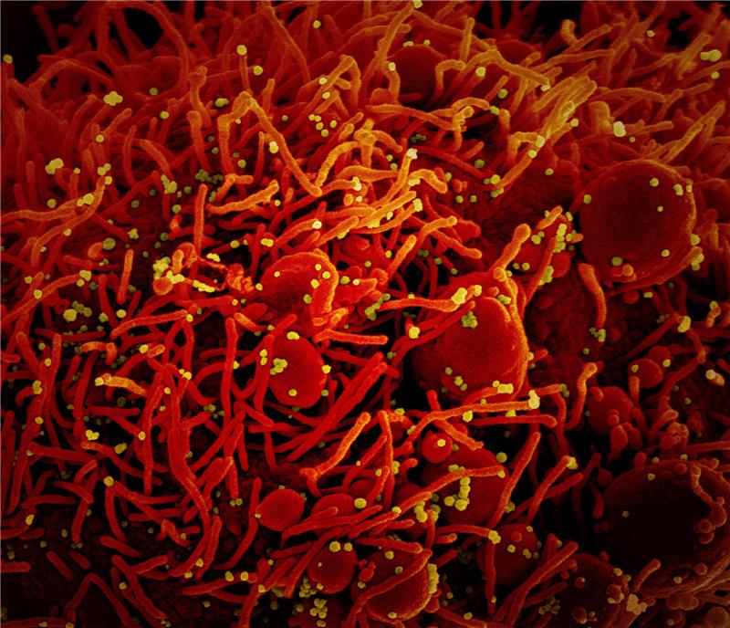Inzidenz im Kreis Stade macht großen Sprung – Weiterer Todesfall Auf dieser vom US-Forschungszentrum "National Institute of Allergy and Infectious Diseases" (NIAID) zur Verfügung gestellten Aufnahme ist eine Zelle (rot) mit dem Coronavirus (SARS-CoV-2, gelb) infiziert. Foto: Niaid/Europa Press/dpa