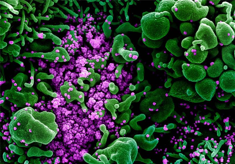 Auf dieser vom US-Forschungszentrum "National Institute of Allergy and Infectious Diseases" (NIAID) zur Verfügung gestellten Aufnahme ist eine Zelle (grün) mit dem Coronavirus (violett) infiziert. Foto: Niaid/Europa Press/dpa