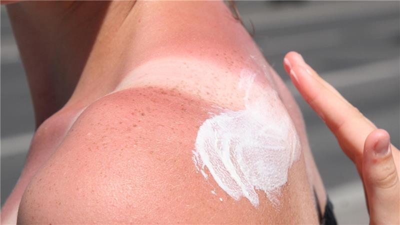 Knallrot und mit Blasen: Was hilft bei starkem Sonnenbrand? Bei Sonnenbrand ist Hautpflege gefragt: Feuchtigkeitsspendende Lotionen mit Aloe vera helfen der geschädigten Haut.