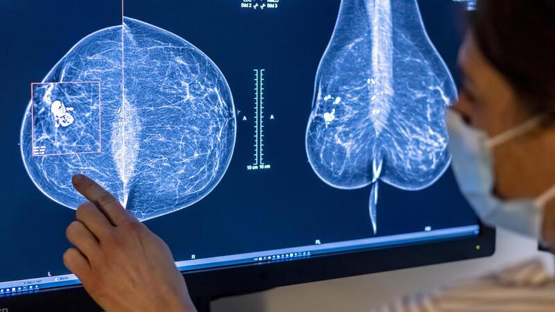 Bei Verdacht auf Brustkrebs helfen etwa Mammografie und Ultraschalluntersuchung bei der Diagnose. (Symbolbild)