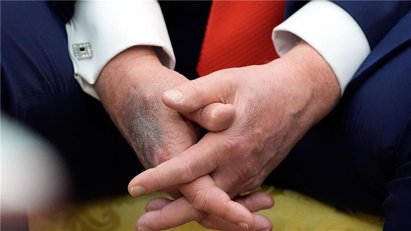 Blaue Flecken geben immer wieder Anlass für Spekulationen. (Archivbild)