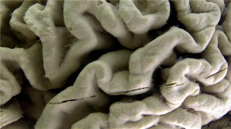 Das Gehirn eines Alzheimer-Patienten zeigt tiefe Furchen. (Illustration)