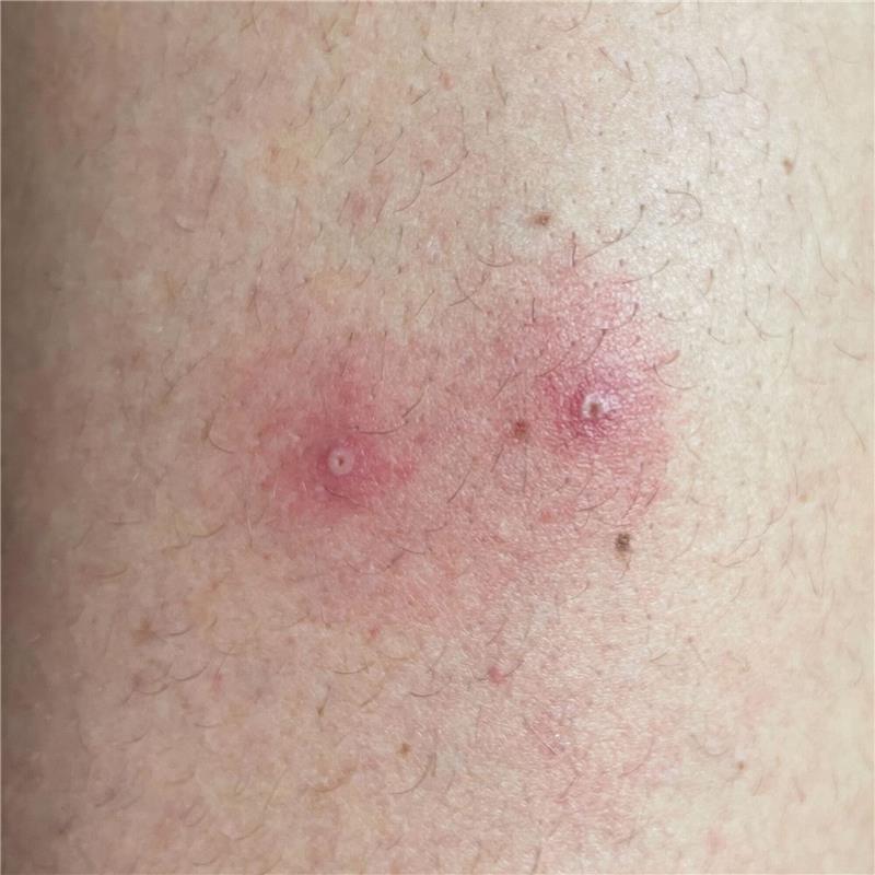 Impfungen gegen Affenpocken in Niedersachsen gestartet Das vom Institute of Tropical Medicine Antwerp zur Verfügung gestellte Foto zeigt Hautsymptome von Affenpocken-Patienten.