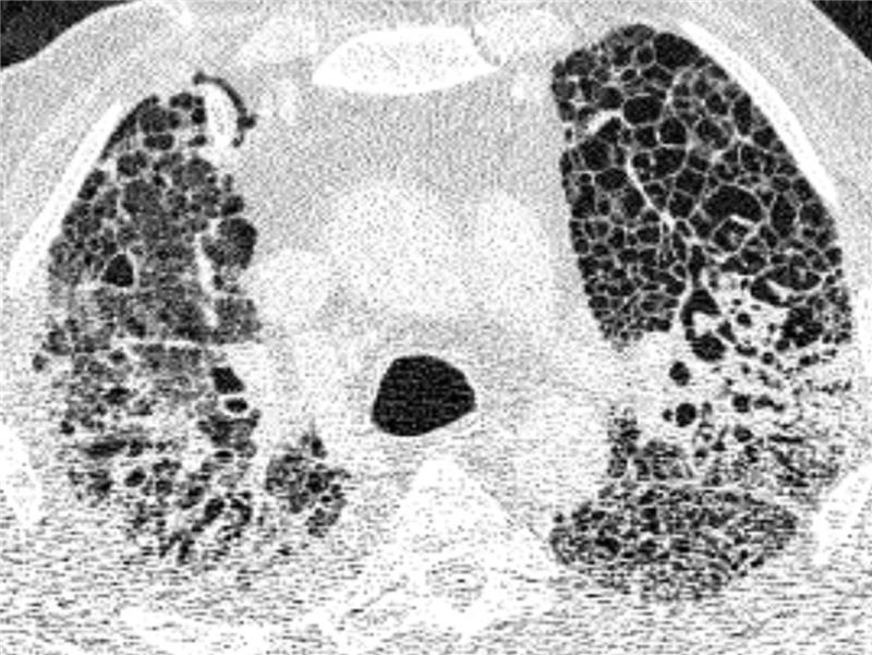 Das CT-Bild der Lunge eines Covid-19-Patienten mit schweren Verlauf. Helle Bereiche zeigen Verdichtungen und Vernarbungen des Lungengewebes. Foto: -/Charité/dpa