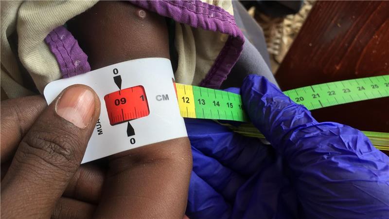 Fortschritte gegen den Hunger - aber nicht überall Der Armumfang eines schwer unterernährten Babys in Somalia wird gemessen. (Archivbild)