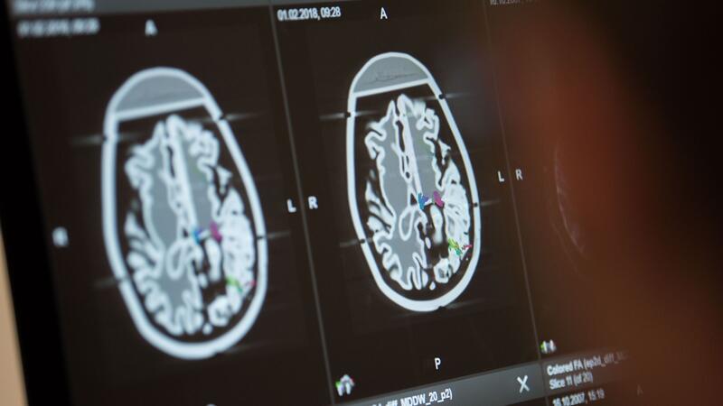Keine nachweisbaren Hirnschäden nach Havanna-Syndrom Die Fallzahlen für Erkrankungen des Nervensystems sind weltweit deutlich gestiegen.
