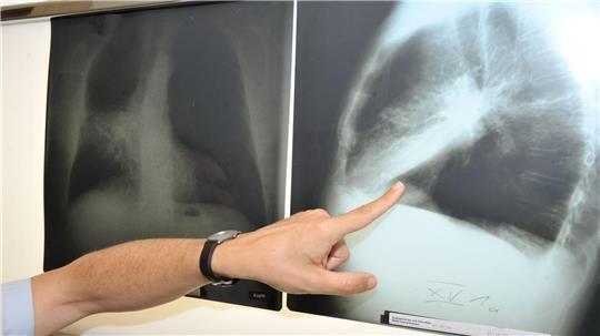 Die Zahl der Krebserkrankungen in Schleswig-Holstein ist nach Zahlen des Krebsregisters leicht gestiegen. (Symbolbild) 