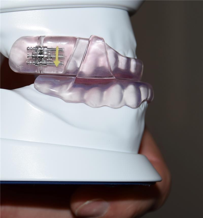 Die Zahnschiene wird in einem speziellen Zahnlabor angefertigt.