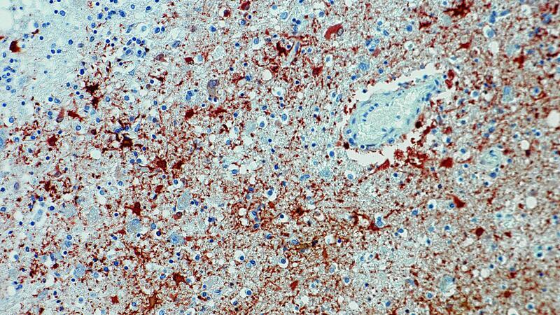 Mensch in Bayern mit Borna-Virus infiziert Die undatierte Aufnahme zeigt einen Anitkörpernachweis zum Borna-Virus im Gewebe.