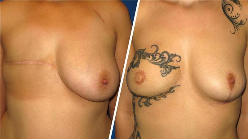 Nach Krebserkrankung: Dr. Dohse baut Brüste wieder auf Diese Patientin hat sich das Narbengewebe nach der Rekonstruktionsoperation mit einem geschmackvollen Tattoo übersechen lassen.