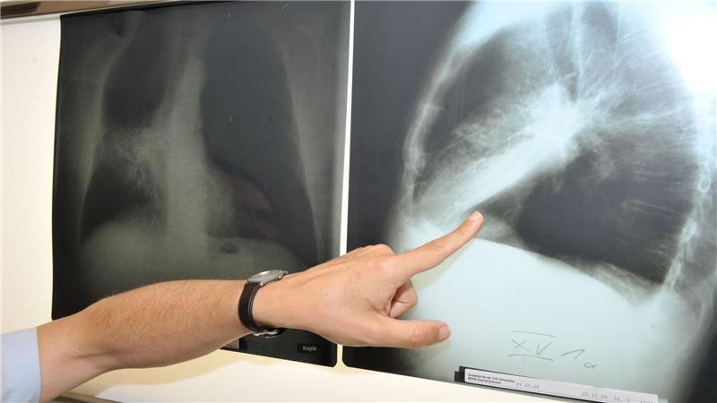 Neue Datenlage: Diese tödliche Krebserkrankung gibt es sehr oft im Kreis Stade Ein Arzt zeigt auf ein Bild einer von Krebs befallenen Lunge.