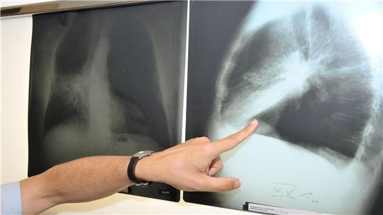 Ein Arzt zeigt auf ein Röntgenbild von einer von Krebs befallenen Lunge. (Illustration)