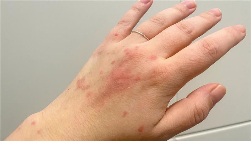 Ein Ausschlag auf der Hand - und meist nicht nur dort: Ein Nesselsucht-Schub verursacht juckende Quaddeln und Rötungen.