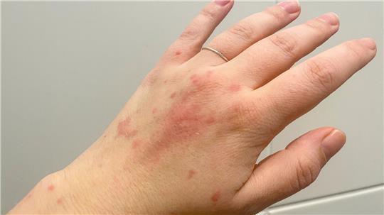 Ein Ausschlag auf der Hand - und meist nicht nur dort: Ein Nesselsucht-Schub verursacht juckende Quaddeln und Rötungen.