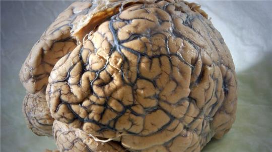 Ein Gehirn des Menschen in einem Labor der Klinik für Neurologie am Universitätsklinikum Jena.