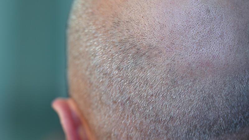 Haarausfall: Was können Männer tun? Ein Mann mit einer Halbglatze. Am 19.11. ist Weltmännertag, ein Aktionstag zur Männergesundheit.