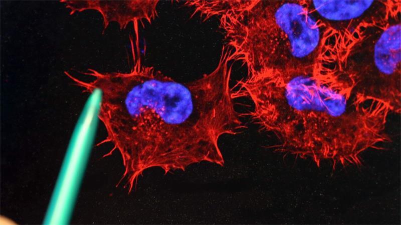 Studie: Hilft die mRNA-Impfung gegen Schwarzen Hautkrebs? Ein Monitor mit einem Bild von Melanom-Zellen. (Archivbild)