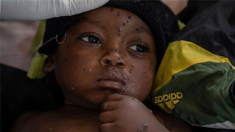 Erster Fall der neuen Mpox-Variante in Deutschland Ein an Mpox erkrankter zweijähriger Junge liegt in einem Krankenhaus in Kamituga im Osten des Kongo.