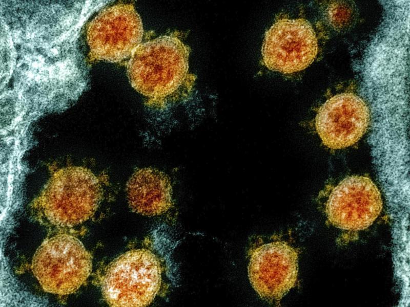 Elektronenmikroskopische Aufnahme von Partikeln des Coronavirus SARS-CoV-2. Foto: Uncredited/NIAID/NIH/dpa