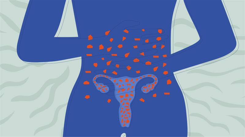 Endometriose kann sich im Körper einer Frau sehr unterschiedlich ausprägen. Häufig sammeln sich die Herde am Bauchfell des Beckens, an den Eierstöcken, der Gebärmutterwand oder an anderen Beckenorganen wie Blase oder Darm.