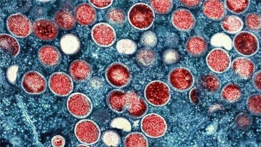 Es gibt Impfstoffe, die den Mpox-Krankheitsverlauf mildern können. (Archivbild)