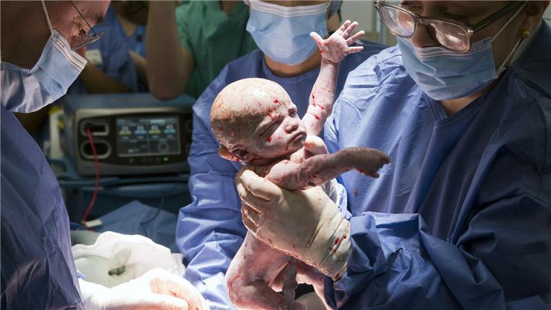 Kleines Wunder: Baby nach Gebärmuttertransplantation geboren Es soll der erste solche Fall in Großbritannien gewesen sein.