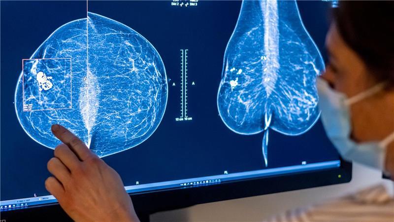 Für Frauen gibt es eine spezielle Untersuchung, um Krebs früh zu entdecken: die Mammografie. (Archivbild)