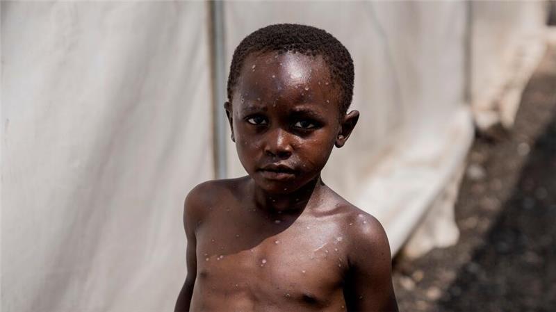 WHO: Mpox-Ausbruch weiter gesundheitliche Notlage Für Kinder und immungeschwächte Menschen kann die Krankheit tödlich sein. (Archivbild)
