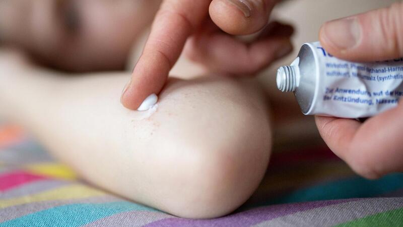 Gerade für Kinder ist Neurodermitis mit besonderem Leidensdruck verbunden. Hier kann die richtige Feuchtigkeitspflege verhindern, dass die Haut zu sehr austrocknet.