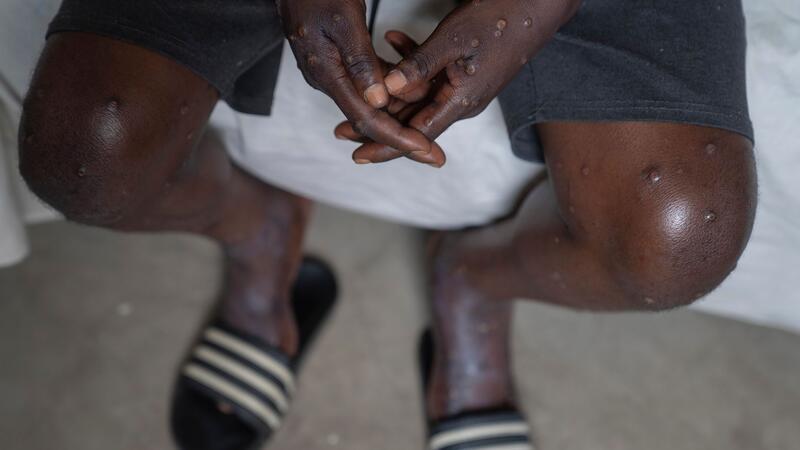 Weltweite Notlage wegen Mpox - nicht genügend Impfstoff In Afrika fehlt Mpox-Impfstoff. (Archivbild)