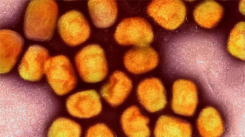 Wegen Mpox: Schule in NRW vorsorglich geschlossen In Deutschland ist zum zweiten Mal die neue Variante des Mpox-Virus nachgewiesen worden, vier Mitglieder einer Familie im Rheinisch-Bergischen Kreis bei Köln sind erkrankt (Archivbild).
