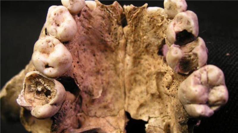 Kariesdefekte bei einem etwa acht Jahre alten Kind. Die Gebisse der Menschen waren in katastrophalem Zustand.