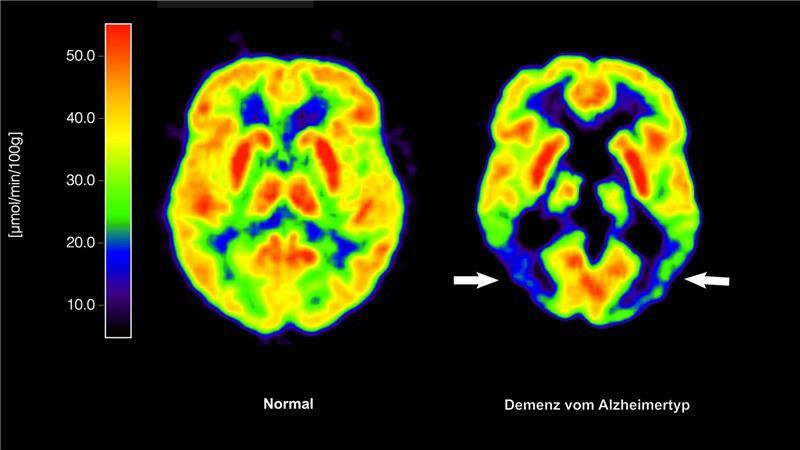 Erstes Alzheimer-Medikament in der EU zugelassen Lecanemab richtet sich gegen Amyloid-Ablagerungen im Gehirn und soll dadurch den Verlauf der Krankheit ein wenig verlangsamen. (Archivbild)