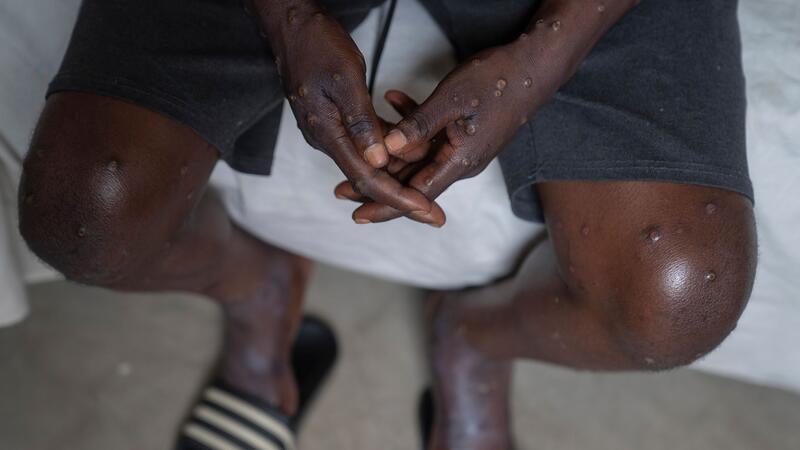 Lockdowns, Massen-Impfungen und Ausgangssperren wegen Mpox? Mehrere Mpox-Ausbrüche in Afrika und eine neue womöglich gefährliche Variante bedrohen die öffentliche Gesundheit weltweit. (Archivbild)
