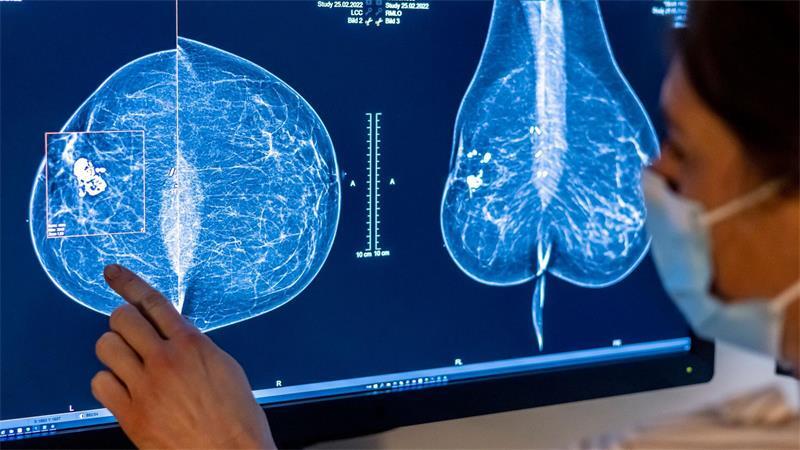 Mit einer Mammografie untersuchen Ärzte die Brust einer Frau auf Brustkrebs - nun gelten geänderte Regeln. (Symbolfoto)