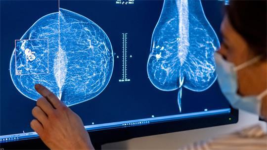 Nach Angaben der Charité leben rund 68.000 Frauen in Deutschland mit Brustkrebs, der Metastasen gebildet hat (Archivbild). 