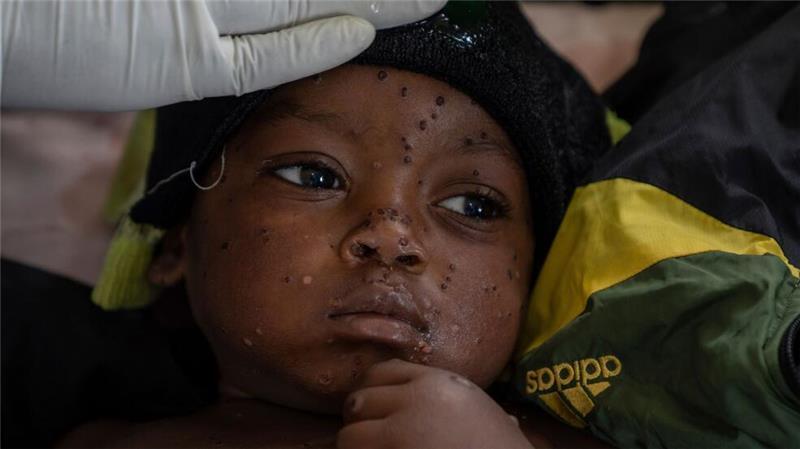WHO gibt grünes Licht für schnelleren Mpox-Test Neue Tests sollen die Ausbreitung von Mpox eindämmen helfen. (Archivbild)