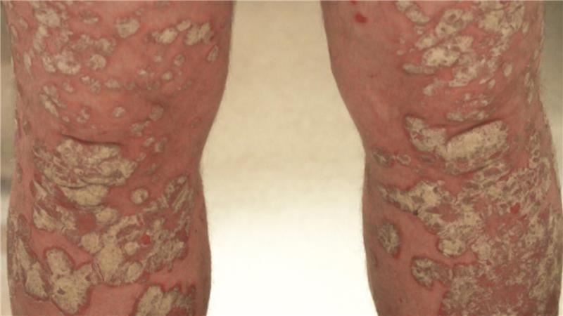 Psoriasis zählt neben Neurodermitis zu den häufigsten Hauterkrankungen überhaupt und ist nicht ansteckend.