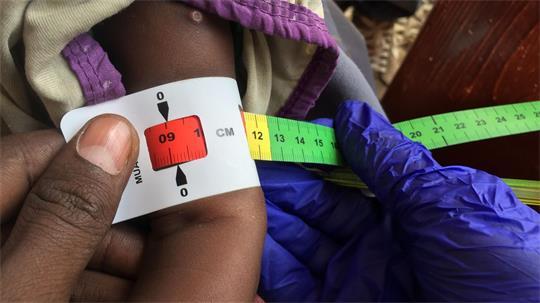 Schon jetzt gelten fast zwei Millionen Kinder in Somalia akut unterernährt. (Archivbild)