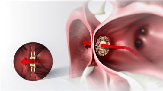So funktioniert das Überdruckventil im Herzen : In ein von den Kardiologen gebohrtes Loch zwischen den Herzkammern wird das Implantat eingesetzt, damit das gestaute Bluf abfließen kann. Grafik: Occlutech.