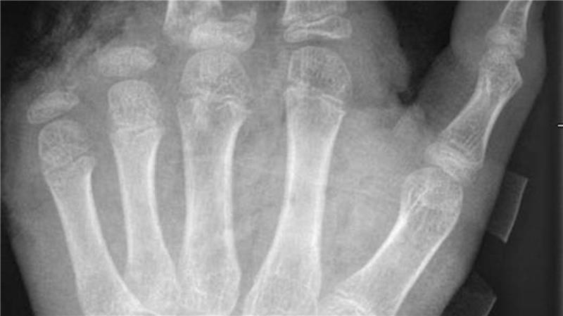 So kann ein Röntgenbild nach einer missglückten Böllerexplosion aussehen: Zwei Finger fehlen.