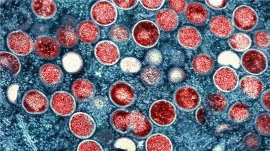 So sieht es unter dem Mikroskop aus: In der zentralafrikanischen Demokratischen Republik Kongo breitet sich das Mpox-Virus aus.