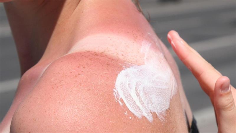 Sonnenbrand ist gefährlich - es drohen Langzeitfolgen.