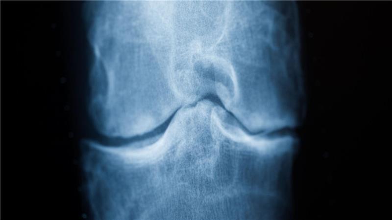 Anders gehen bei Knie-Arthrose könnte helfen Spätestens das Röntgenbild schafft Klarheit: Der Knorpel nutzt sich immer mehr ab. Im späteren Stadium einer Arthrose reibt Knochen direkt auf Knochen. (Archivbild)