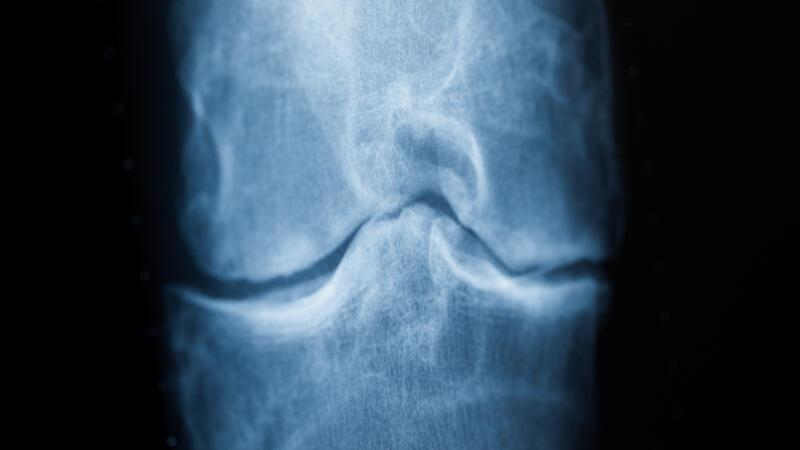 Röntgenaufnahme eines Knies mit Arthrose