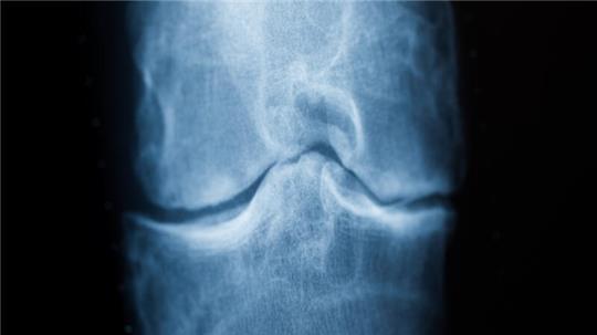 Röntgenaufnahme eines Knies mit Arthrose